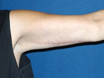 Arm Lift Before & After Gallery - Patient 173564973 - Image 2