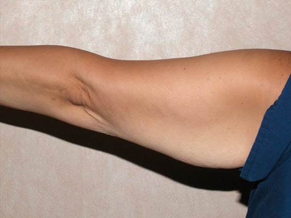 Arm Lift Before & After Gallery - Patient 173564973 - Image 3