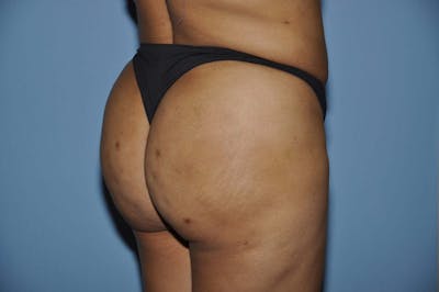 Brazilian Butt Lift Before & After Gallery - Patient 173564971 - Image 4