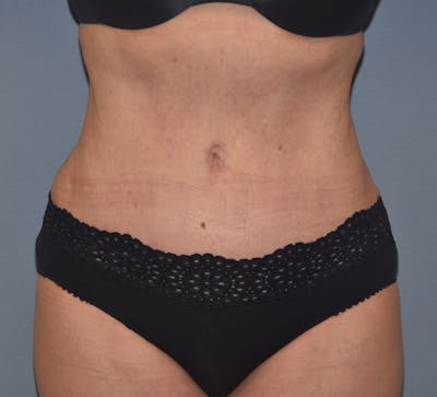 Tummy Tuck Before & After Gallery - Patient 173564984 - Image 2