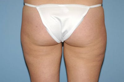 Liposuction Before & After Gallery - Patient 173564978 - Image 1