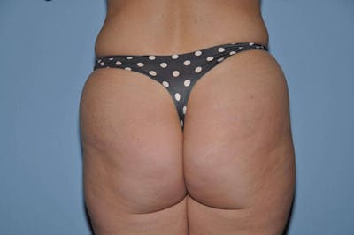 Brazilian Butt Lift Before & After Gallery - Patient 173564976 - Image 1