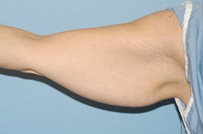 Arm Lift Before & After Gallery - Patient 173564977 - Image 1