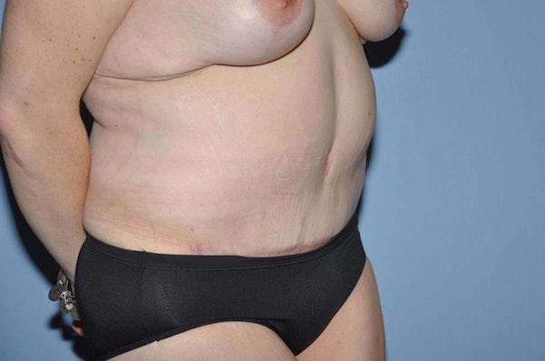 After Weight Loss Surgery Before & After Gallery - Patient 173564979 - Image 4