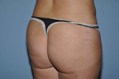 Brazilian Butt Lift Before & After Gallery - Patient 173564976 - Image 4