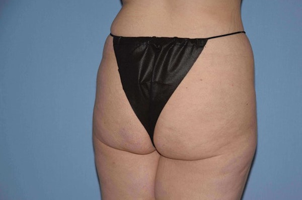 Brazilian Butt Lift Before & After Gallery - Patient 173564981 - Image 3