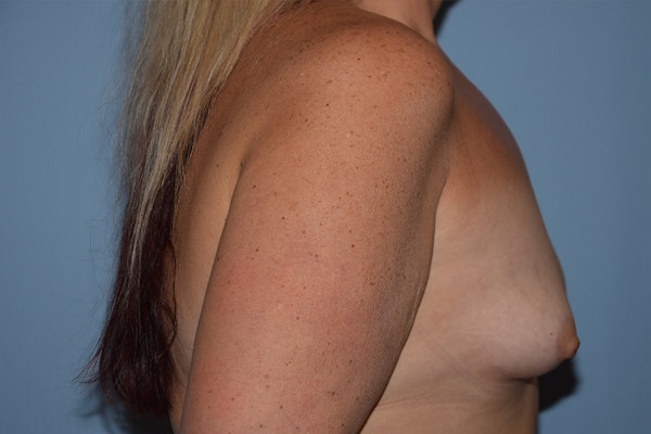 Breast Augmentation Before & After Gallery - Patient 173564983 - Image 5