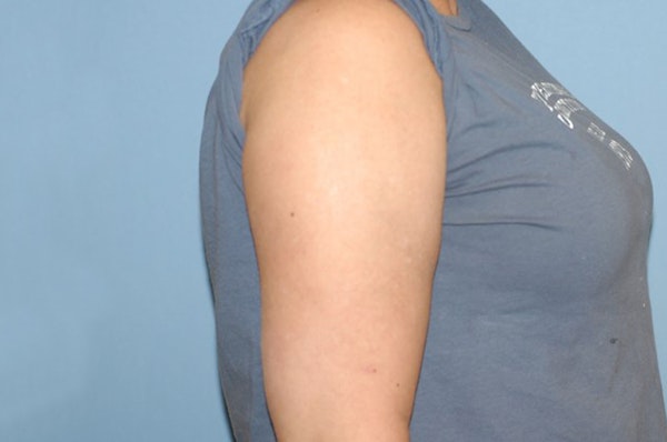 Arm Lift Before & After Gallery - Patient 173564985 - Image 4