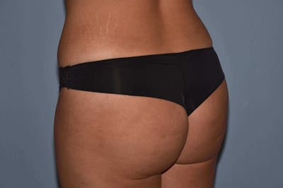 Brazilian Butt Lift Before & After Gallery - Patient 173564989 - Image 2