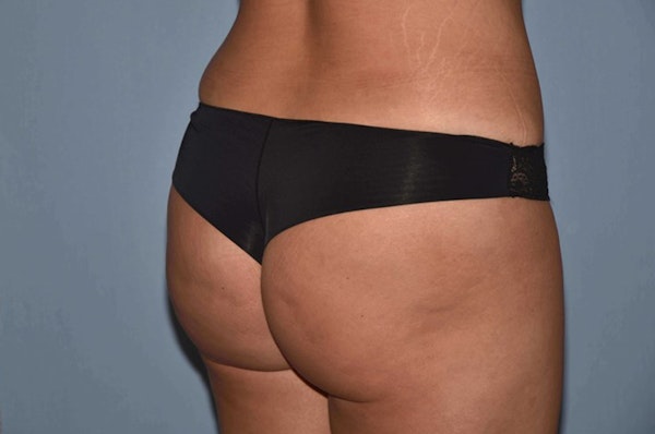 Brazilian Butt Lift Before & After Gallery - Patient 173564989 - Image 4