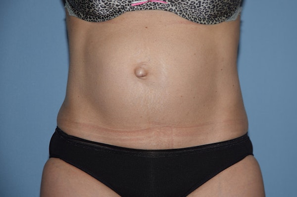Tummy Tuck Before & After Gallery - Patient 173564994 - Image 1