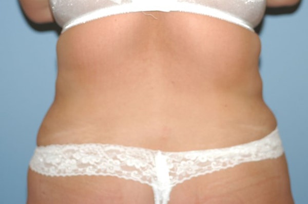 Liposuction Before & After Gallery - Patient 173564987 - Image 8