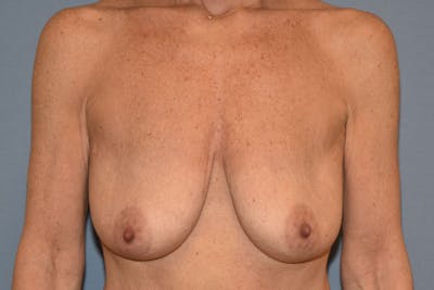 Breast Augmentation Lift Before & After Gallery - Patient 173564999 - Image 1