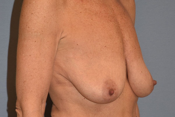 Breast Augmentation Lift Before & After Gallery - Patient 173564999 - Image 3