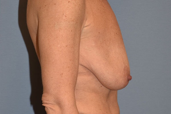 Breast Augmentation Lift Before & After Gallery - Patient 173564999 - Image 5