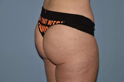 Liposuction Before & After Gallery - Patient 173565003 - Image 4