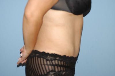After Weight Loss Surgery Before & After Gallery - Patient 173565000 - Image 6
