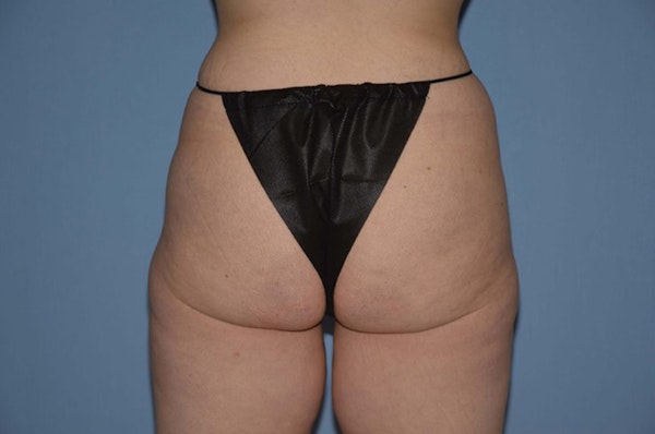 Brazilian Butt Lift Before & After Gallery - Patient 173565007 - Image 1