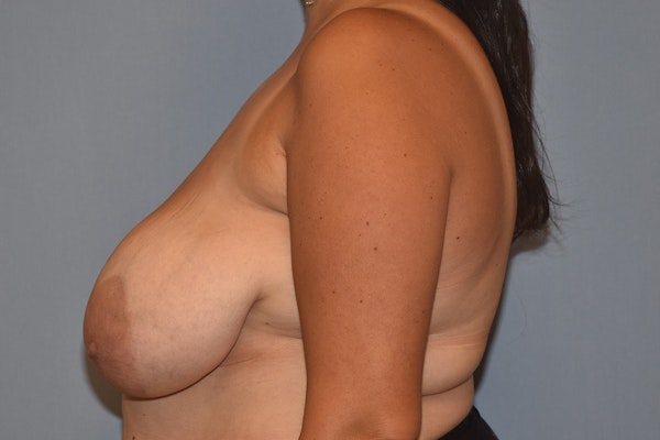 Breast Reduction Before & After Gallery - Patient 173565004 - Image 5