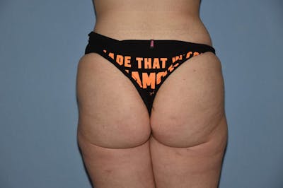 Brazilian Butt Lift Before & After Gallery - Patient 173565007 - Image 2