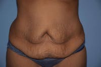 After Weight Loss Surgery Before & After Gallery - Patient 173565010 - Image 1