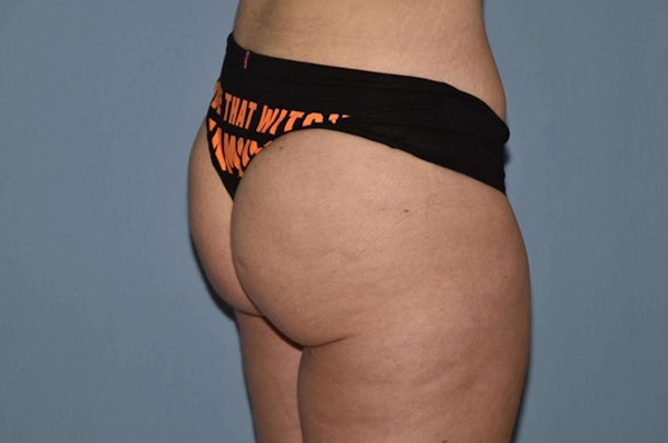 Brazilian Butt Lift Before & After Gallery - Patient 173565007 - Image 4