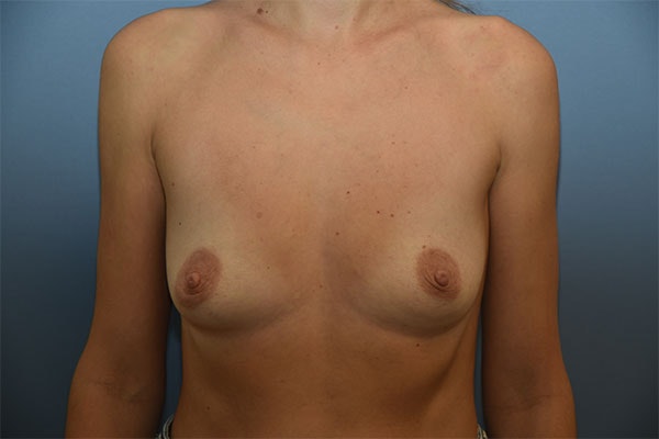 Breast Augmentation Before & After Gallery - Patient 173565013 - Image 1