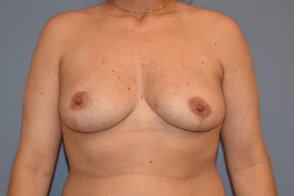 Breast Reduction Before & After Gallery - Patient 173565012 - Image 2