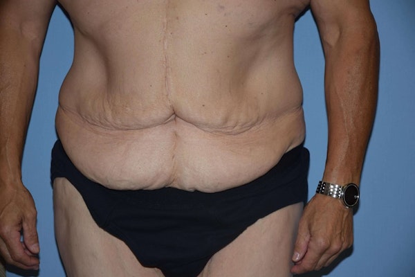 After Weight Loss Surgery Before & After Gallery - Patient 173565023 - Image 1