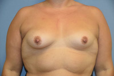 Breast Augmentation Before & After Gallery - Patient 173565024 - Image 1