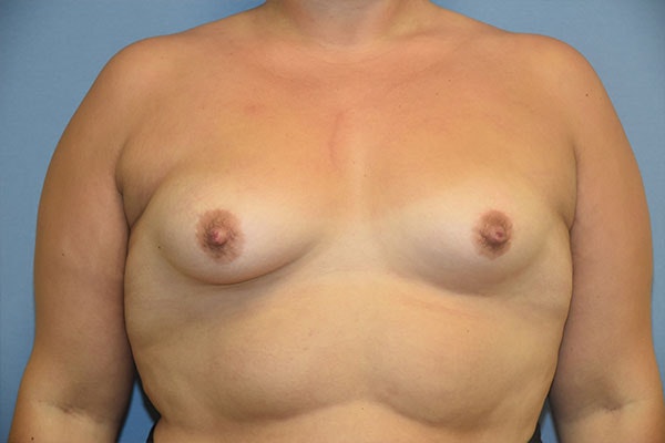 Breast Augmentation Before & After Gallery - Patient 173565024 - Image 1