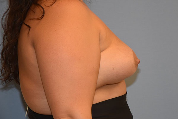 Breast Augmentation Before & After Gallery - Patient 173565024 - Image 6