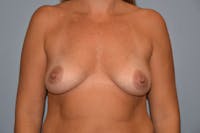 Breast Augmentation Before & After Gallery - Patient 173565061 - Image 1