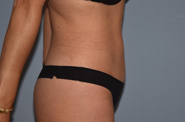 Liposuction Before & After Gallery - Patient 173565027 - Image 8