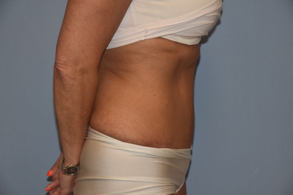 Tummy Tuck Before & After Gallery - Patient 173565066 - Image 6