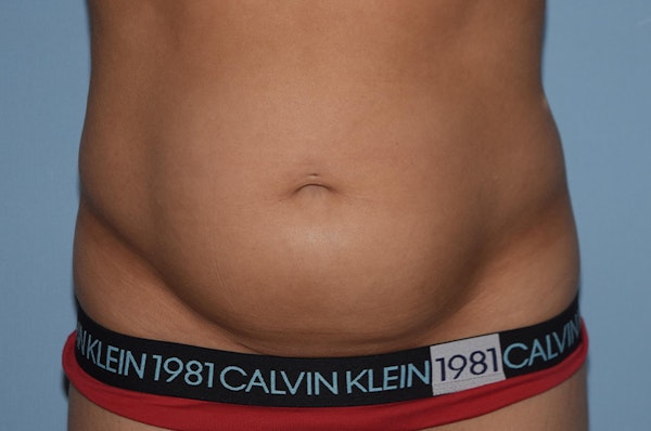 Tummy Tuck Before & After Gallery - Patient 173565334 - Image 1