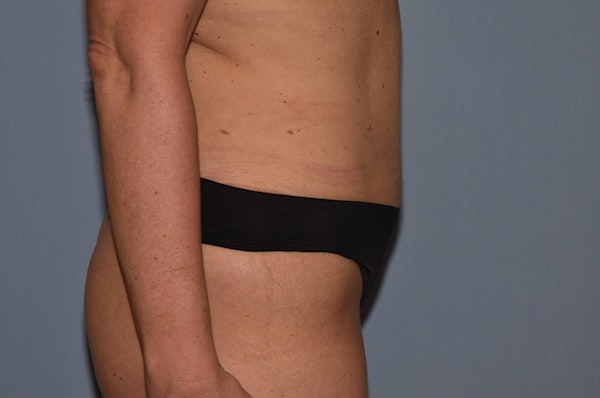 Liposuction Before & After Gallery - Patient 173565229 - Image 4