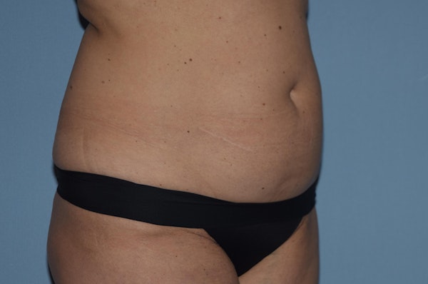 Liposuction Before & After Gallery - Patient 173565229 - Image 5