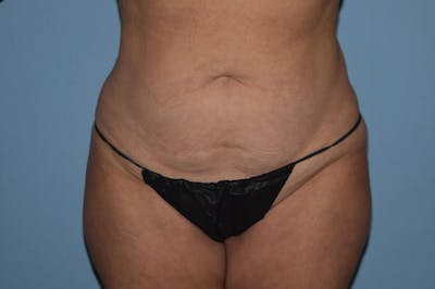 Liposuction Before & After Gallery - Patient 173565523 - Image 1