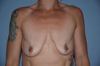 Breast Augmentation Lift Before & After Gallery - Patient 173565493 - Image 1