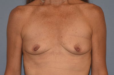 Breast Augmentation Before & After Gallery - Patient 173565522 - Image 1