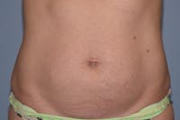 Tummy Tuck Before & After Gallery - Patient 173565554 - Image 1