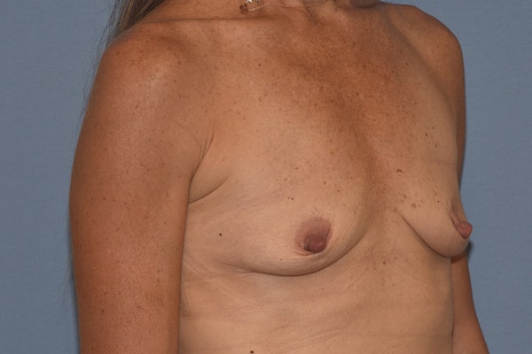 Breast Augmentation Before & After Gallery - Patient 173565522 - Image 3