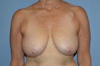 Breast Lift Before & After Gallery - Patient 173565586 - Image 1
