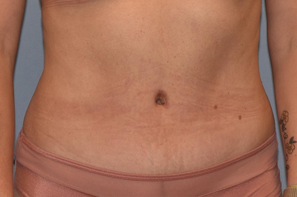 Liposuction Before & After Gallery - Patient 173565599 - Image 2