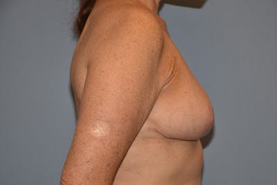 Breast Lift Before & After Gallery - Patient 173565586 - Image 6