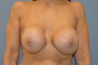 Breast Revision Before & After Gallery - Patient 173565601 - Image 1