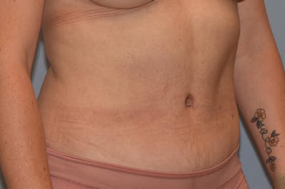 Liposuction Before & After Gallery - Patient 173565599 - Image 4