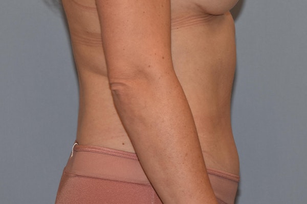 Liposuction Before & After Gallery - Patient 173565599 - Image 6