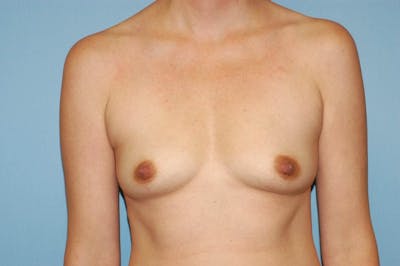 Breast Augmentation Before & After Gallery - Patient 173565606 - Image 1